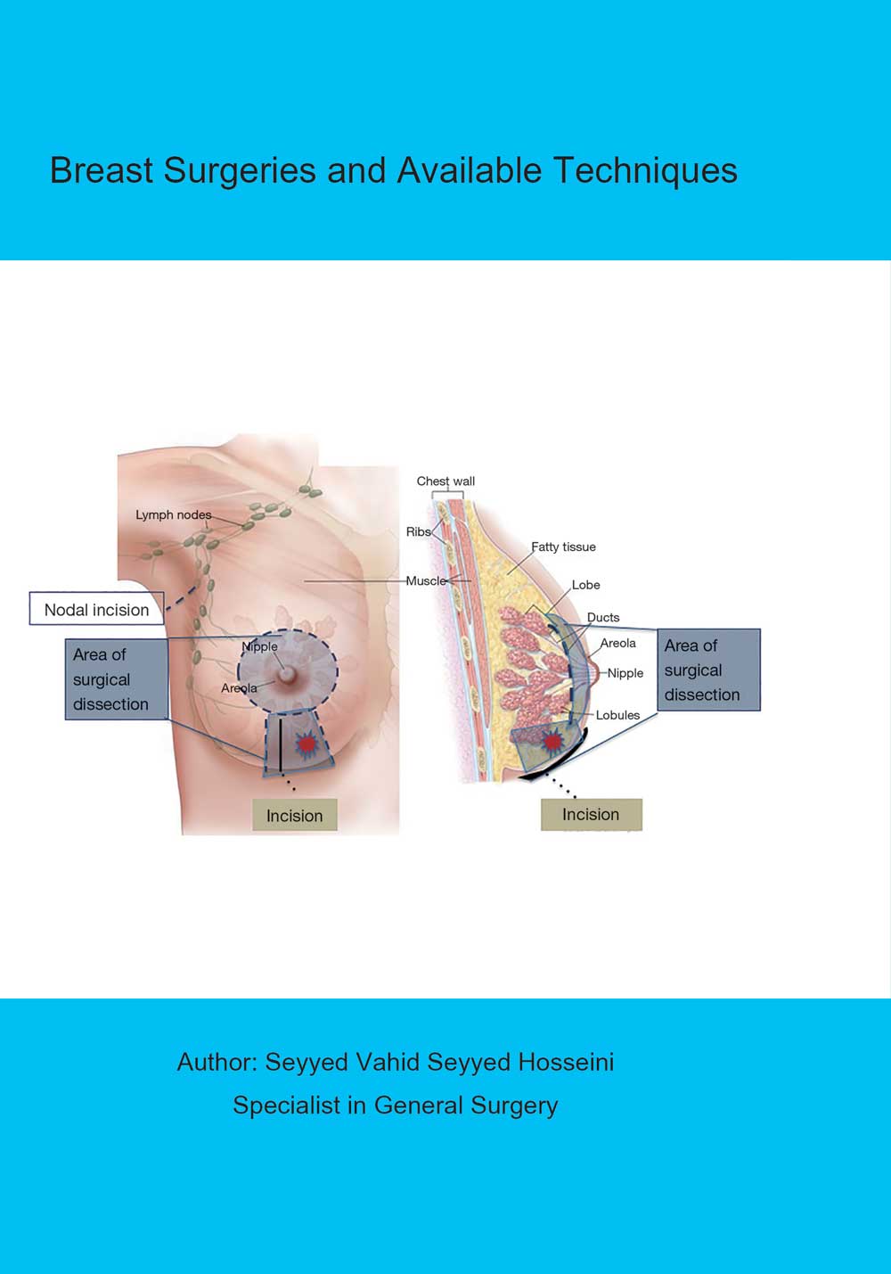 Breast Surgeries and Available Techniques